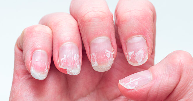 Rippled Fingernails Might Be Trying to Tell You Something About Your Health